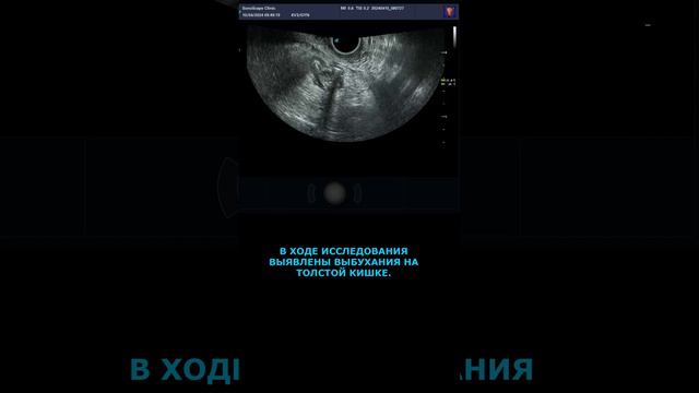 Дивертикулы кишки внутриполостным датчиком смотреть онлайн