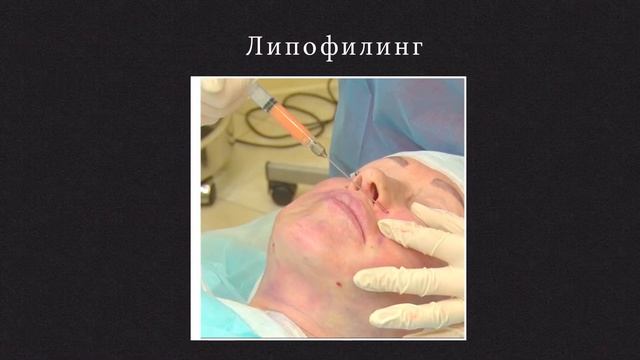 Омоложение верхней и средней трети лица смотреть онлайн