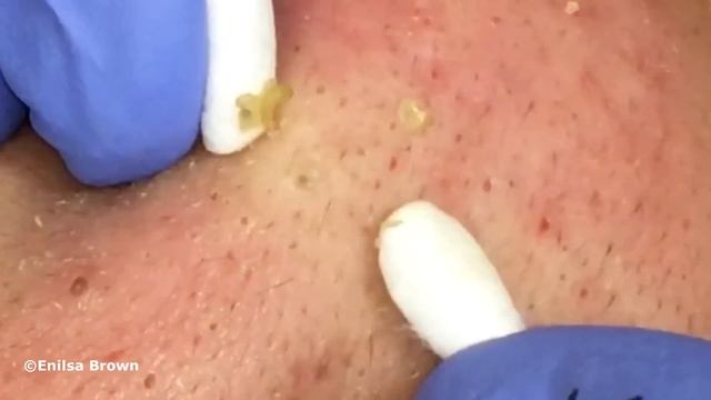 Special "K" Blackhead Extractions 11th Treatment Part 2