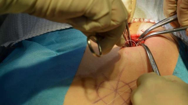Устранение грыжи белой линии живота и сопутствующей пупочной грыжи