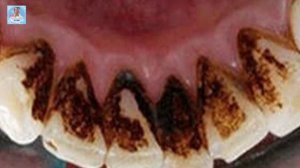 Коричневый налет на зубах!?