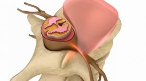 Остеохондроз симптомы и лечение