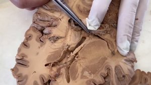 ПРЕПАРИРОВАНИЕ ГОЛОВНОГО МОЗГА. ИЗУЧЕНИЕ ЕГО СТРУКТУР