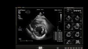УЗИ сердца .Способ определения индекса массы миокарда площадь длина.