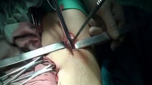 Техника формирования кишечных стом (часть 1)