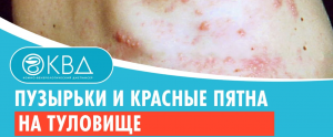 ? Пузырьки и красные пятна на туловище. Клинический случай №934