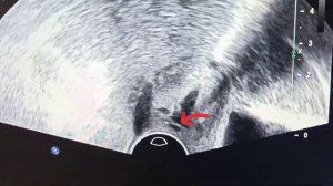 полип шейки матки (полип цервикального канала, cervical canal polyp)