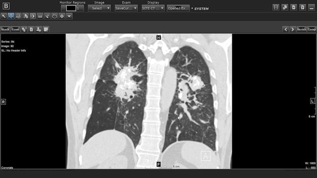 Upper Lung Predominant Fibrosis смотреть онлайн