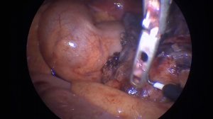 Лапароскопическая аппендэктомия. Гангренозный аппендицит.Инфильтрат3