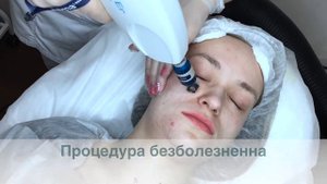 Фракционная лазерная шлифовка