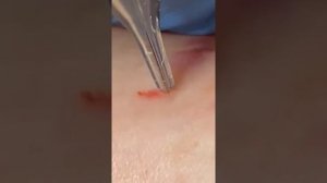 ремувер для удаления татуажа