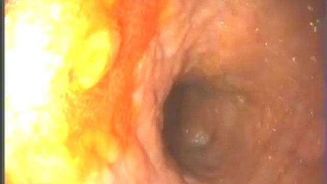 Дуоденоскопия, Москва, внутр HDTV смотреть онлайн