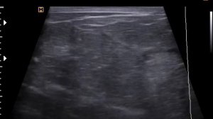 Острый мастит (1-11-17)