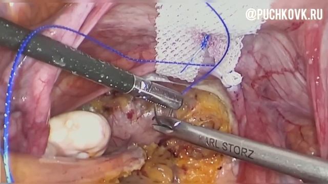 Лапароскопическая коррекция генитального пролапса сетчатым имплантом по авторской методике