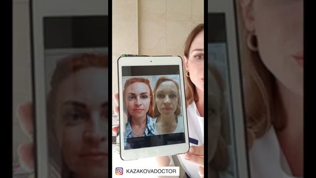 Нити АПТОС - до/после. Казакова Доктор. Красноярск