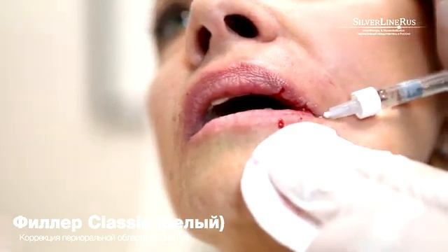 Коррекция периоральной области и зоны губ филлером Classic белый. смотреть онлайн