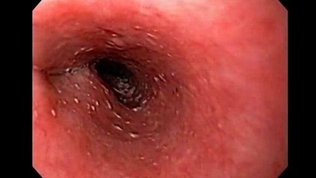 Esofagitis Infecciosa смотреть онлайн