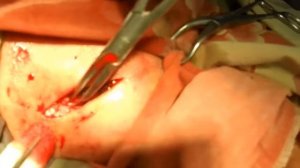 Branchial Cyst / Боковая киста шеи