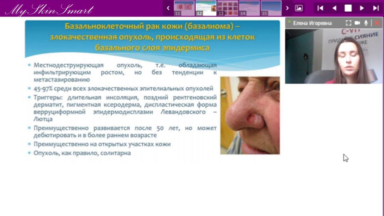 Лекция 18  Невусы и меланома  Предраковые заболевания и опухоли кожи