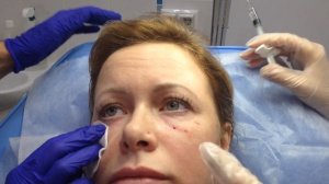 АирисКом: обучение студентов. МОРЩИНЫ заполнение морщин в ОБЛАСТИ ГЛАЗ