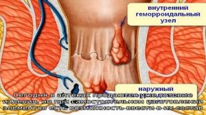 Правила приготовления свечей с мумие для лечения геморроя