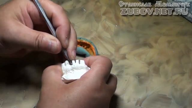 Изготовление зубных штампованных коронок. Гравировка шеек зуба смотреть онлайн