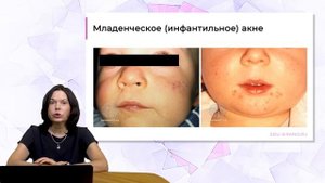 18:30 09.04.2023 Акне у детей и подростков