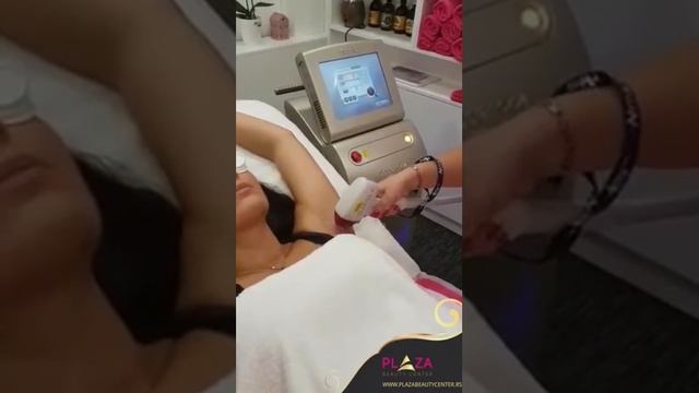 Epilacija laserom SOPRANO XL 2017 - Plaza Beauty Center