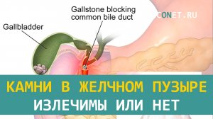 Камни в желчном пузыре излечимы или нет