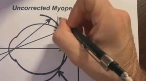 Миопия (близорукость) video-2