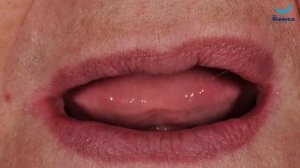 Изготовление полных съёмных протезов на верхнюю и нижнюю челюсть  Бутаев А С  Клиника Dr Smile