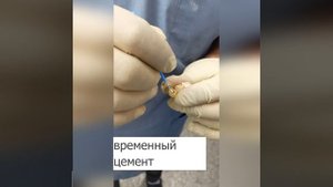 Мостовидный протез — пример замещения одного зуба