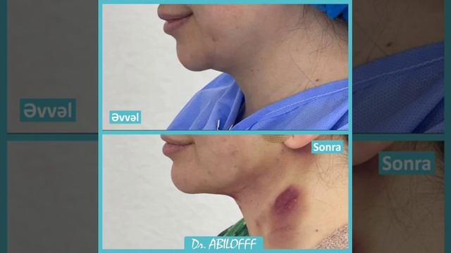 Buxağın EndoLazer Liporeduksiyası - Estetik Cerrah