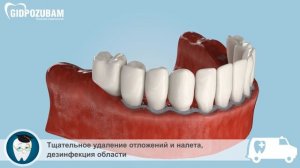 Шинирование зубов. Стекловолоконное шинирование зубов.