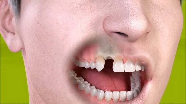 Straumann Керамические импланты ШТРАУМАН смотреть онлайн