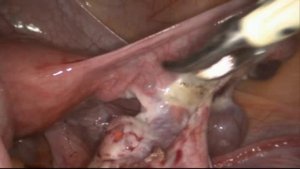 Правосторонняя тубэктомия