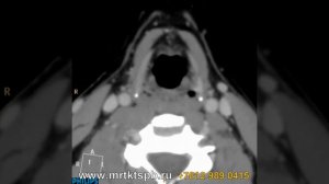 Компьютерная томография гортани (КТ)