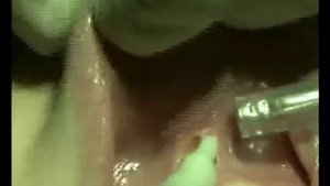 Френэктомия, пластика уздечки языка, диодный лазер