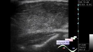 УЗИ щитовидной железы - Зоб Хашимото