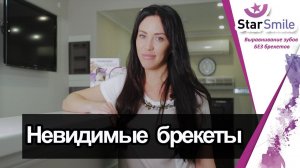 Видео отзыв пациента о лечении на элайнерах для выравнивания зубов