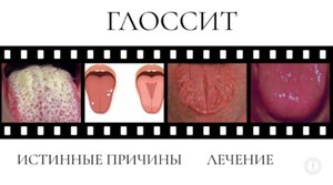 ГЛОССИТ?! ОТКУДА БЕРЕТСЯ НАЛЕТ ВО РТУ И НЕПРИЯТНЫЙ ЗАПАХ?