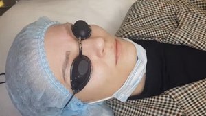 Удаление татуажа неодимовым лазером