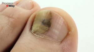 Эффективная Мазь От Грибка На Ногах И Руках, 100% Результат!