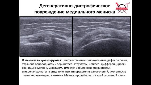 #УЗИ менисков коленного сустава смотреть онлайн