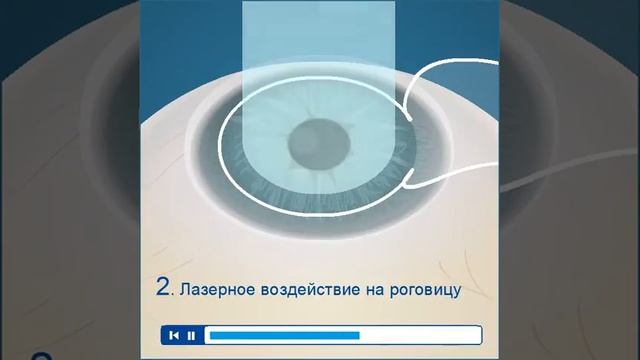 ЛАСИК (лазерный кератомилез) смотреть онлайн