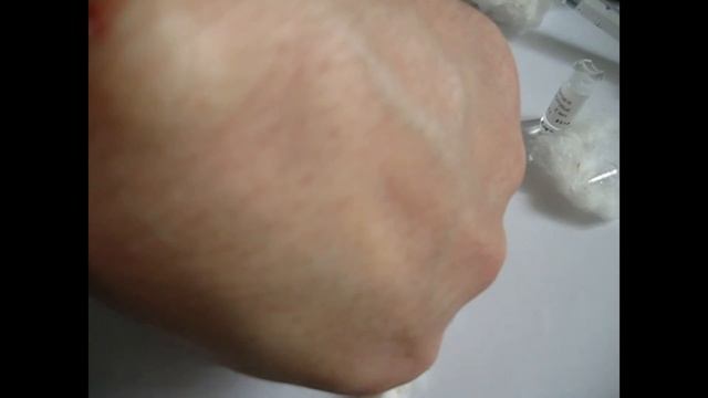 Сам себе доктор (Удаление гигромы 18+) / Be Your Own Doctor (removal hygroma 18+) смотреть онлайн