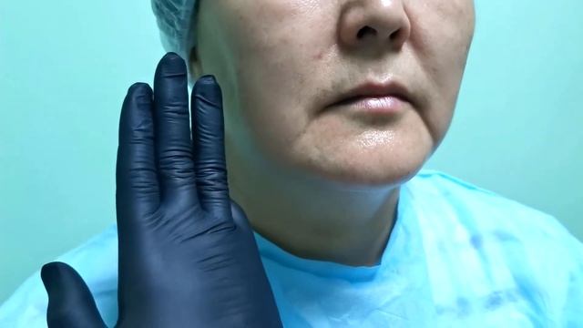 Заполнение носогубных складок филлером в Атырау