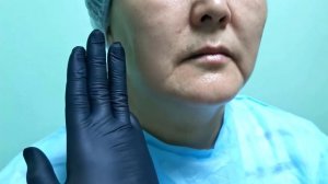 Заполнение носогубных складок филлером в Атырау