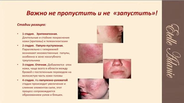 Как убрать покраснения и сосудистые сеточки на лице?