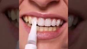 Отбеливающая ручка для зубов удаляет зубной камень и зубной камень, чистит рот